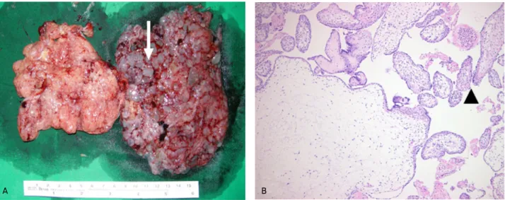 Fig. 3. Pathologic findings. (A) Gross picture of the molar placenta (arrow) showing a diffuse cluster of molar vesicles