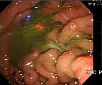 Fig. 2. At the gastroscope, moderate amount of greenish  mucus pool was noted at the fundus