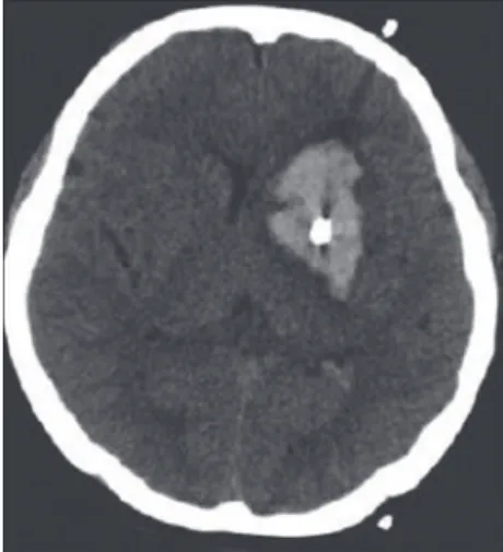 Fig. 1. Secondary headache due to cerebral hemorrhage.