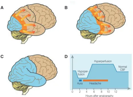 Fig. 2. Cerebral blood flow (CBF) during aura.