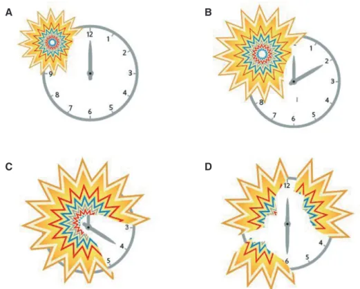 Fig. 3. Visual aura in migraine patient.