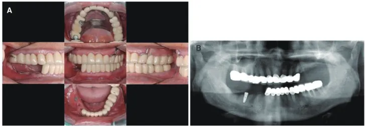Fig. 2. Diagnosis. (A) Face-bow transfer, (B) Bite registration, (C) Diagnostic wax-up.
