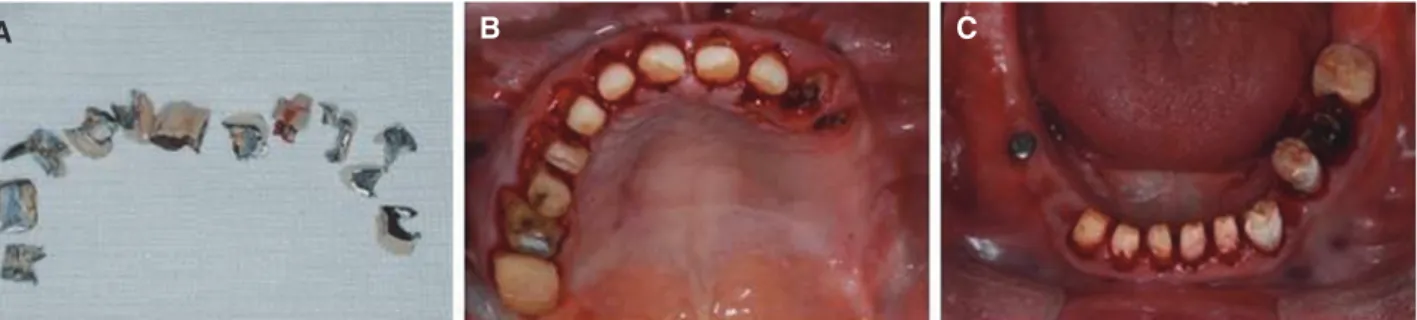 Fig. 3. Removal of old porcelain fused metal fixed prosthesis. (A) Removed prosthesis, (B) Maxillary abutments, (C)  Mandibular abutment.