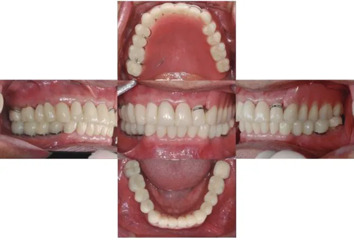 Fig. 5. Temporary prosthesis setting.
