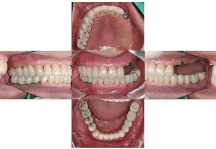 Fig. 8. (A) Border molding, (B) Final impression, (C) Framework fabrication, (D) Delivery.