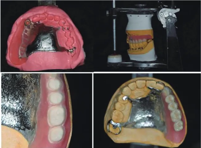 Fig. 10. Final prosthesis setting. (A) Intra-oral photograph, (B) Panoramic radiograph.
