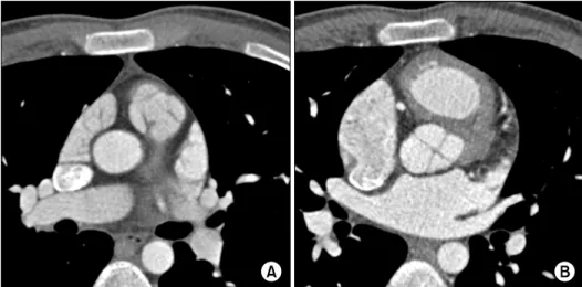 Fig. 2. Operative findings show quadricuspid pulmonary valve and  3-fused commissures
