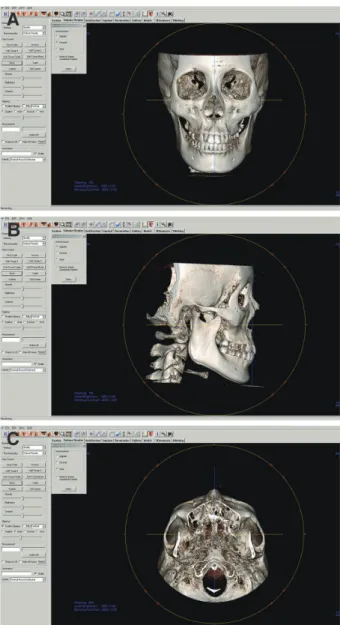 Fig. 4. Condyle-incisor distance.