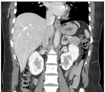 Fig. 2. Postoperative 3-dimensional liver CT scan showing no evi- evi-dence of thrombus recurrence at operation site.