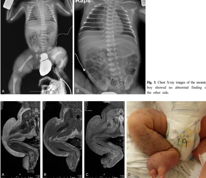 Fig. 3. Chest X-ray images of the neonatal boy showed no abnormal finding of  the other side.