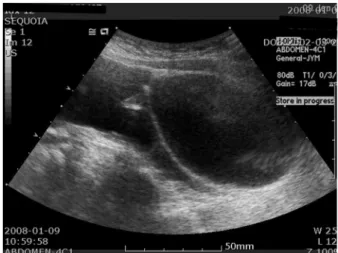 Fig. 1. Transabdominal ultrasonogram shows huge multiple  septated hypoechogenic cystic mass with some mixed echogenic area and posterior acoustic shadowing.