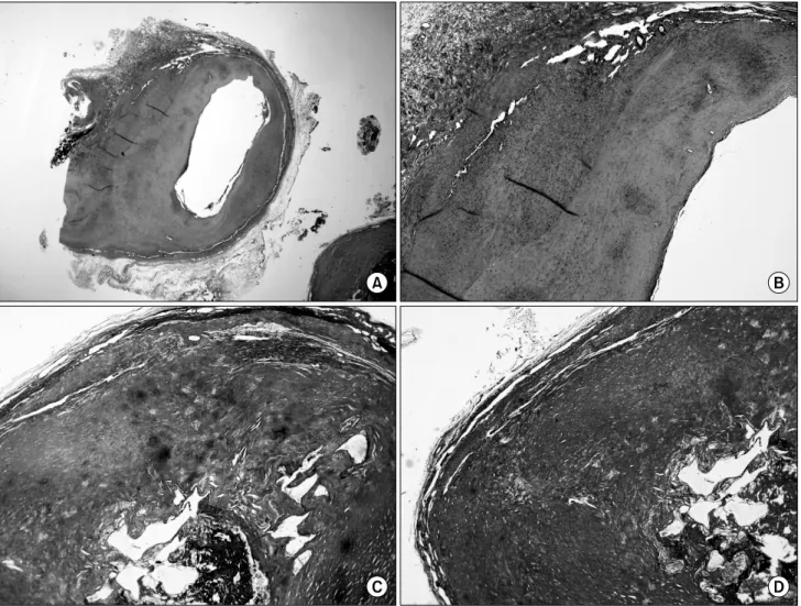 Fig. 3. Histologic finding of resected aneurysm. (A) Contains whole arterial vessel component (H&amp;E stain, x12)