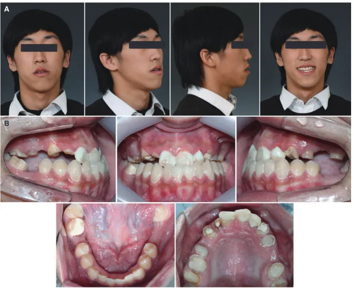 Fig. 3. Pretreatment (before orthognathic surgery)  lateral cephalometric radiograph and analysis