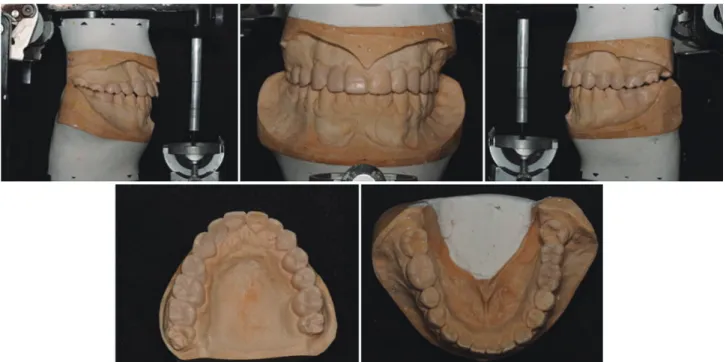 Fig. 9. Set-up model for final prosthetics.