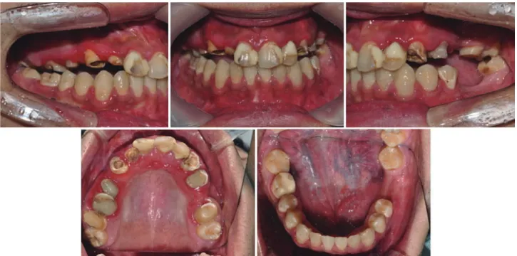 Fig. 10. Post-orthodontic treatment. Maintain vertical position on mandibular teeth. #46 was protracted.