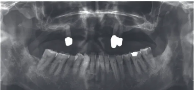 Fig. 2. Intraoral view (A) and panoramic radiograph (B) after implant placement.