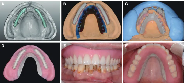 Fig. 6. Design &amp; fabrication of spra-structure of milled zirconia bar with CAD/CAM