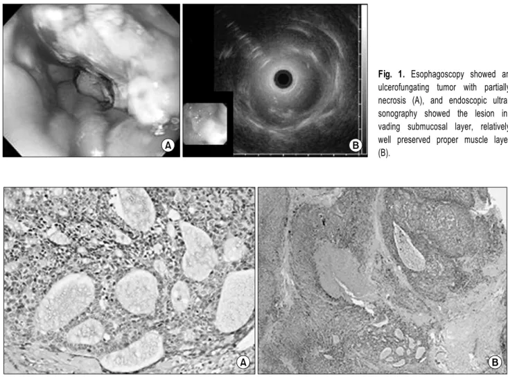 Fig. 1. Esophagoscopy showed an  ulcerofungating tumor with partially  necrosis (A), and endoscopic  ultra-sonography showed the lesion  in-vading submucosal layer, relatively  well preserved proper muscle layer  (B).
