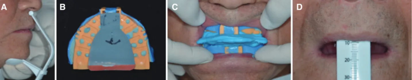 Fig. 3. (A) Jaw gauge used to determine the vertical dimension, (B) Gothic-arch tracing with the EZ-tracer, (C) Jaw  relation recording, (D) Lip ruler used to measure length of upper lip.