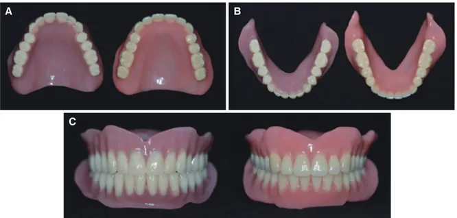 Fig. 5. (A) Extra-oral photograph the patient wearing DENTCA CAD/CAM complete dentures, (B) Extra-oral photograph  of the patient wearing conventional complete dentures.