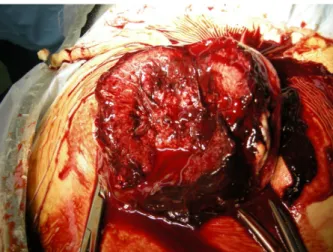 Fig. 1. Amniotic sac and hematoma that was exposed directly  after entering abdominal cavity.