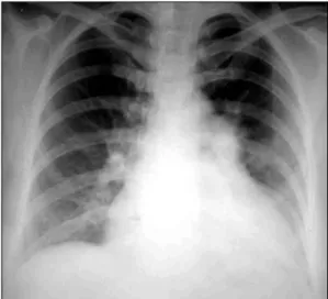 Fig. 1. Preoperative chest PA, showing cardiomegaly, increas- increas-ed  pulmonary conus and vascularity.