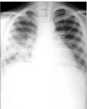 Fig. 2. Preoperative perfusion lung scan shows perfusion  defect on right lower lung field.