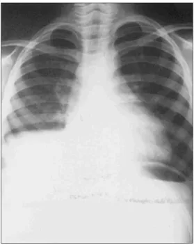 Fig. 5. Post operative chest PA.