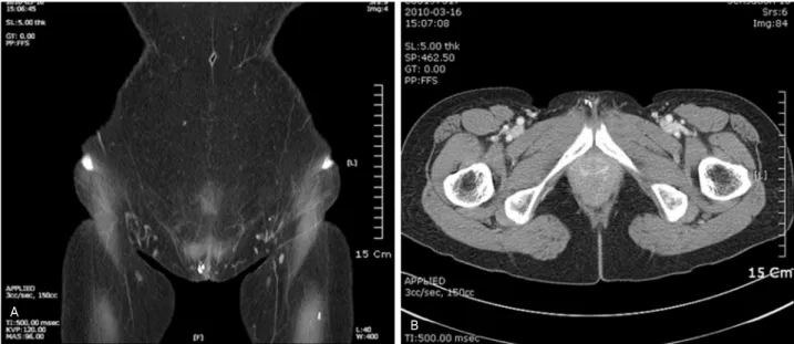 Fig. 1. CT showed nonenhancing multiple nodular lesions at right sided vulva. (A) Coronal view of vulva and perineum