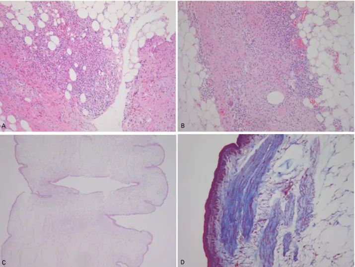 Fig. 3. There were pathologic findings. (A) Microscopic findings showed massive infiltration of acute and chronic inflammatory cells  containing many eosinophils (H&amp;E stain, ×100)
