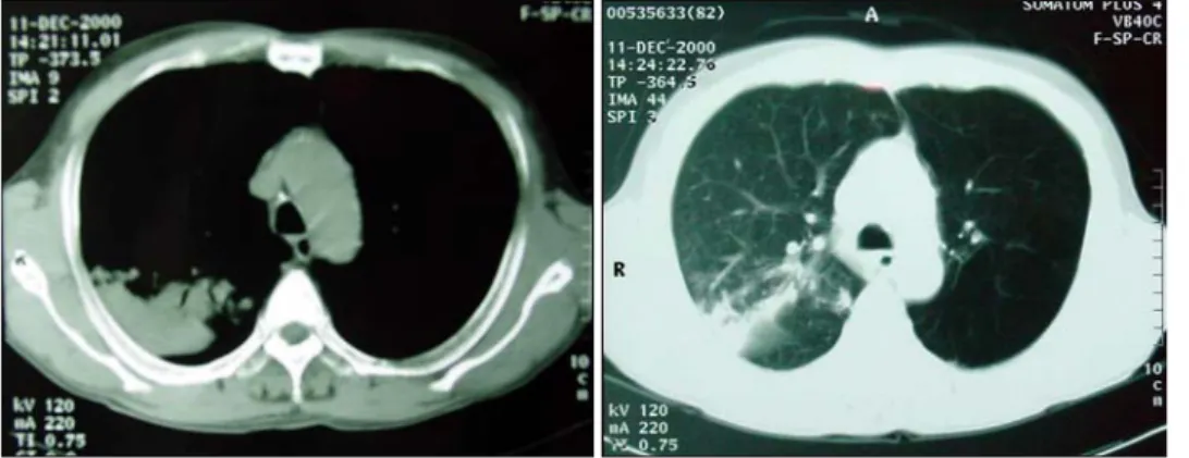 Fig. 3. The pre-operative bronchoscopic finding revealed a  protruding mass on the right upper lobe bronchus.