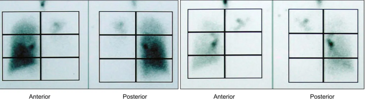 Fig. 4. The ventilation-perfusion scan shows a unilateral matched ventilation and perfusion defect on left lung and right upper lung.