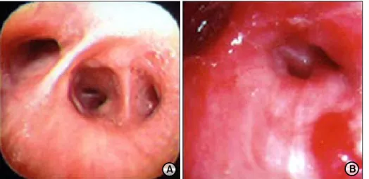 Fig. 2. Pre-operative bronchos- bronchos-copy. A: The bronchoscopy one  year ago was nonspecific  find-ing