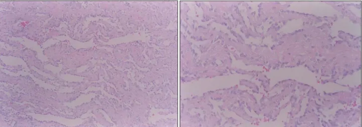 Fig. 3. The microscopic finding showed irregular anastomosing vascular channels lined by a single layer of enlarged endothelial  cells  permitting between collagen bundles (the vascular lumen are bloodless)  (H-E××100, 400).
