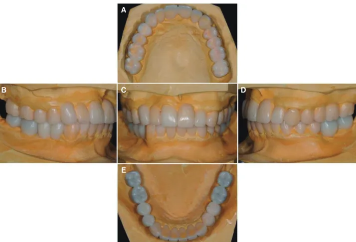 Fig. 3. Diagnostic wax-up model with increased vertical dimension. (A) Maxillary occlusal view, (B) Right lateral view, (C)  Frontal view, (D) Left lateral view, (E) Mandibular occlusal view.