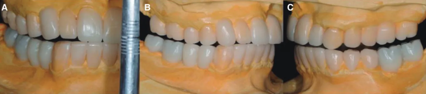 Fig. 5. 1st provisional restoration.