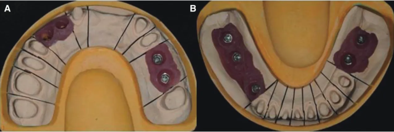 Fig. 7. Working cast for definitive prosthesis. (A) Maxillary occlusal view, (B) Mandibular occlusal view.