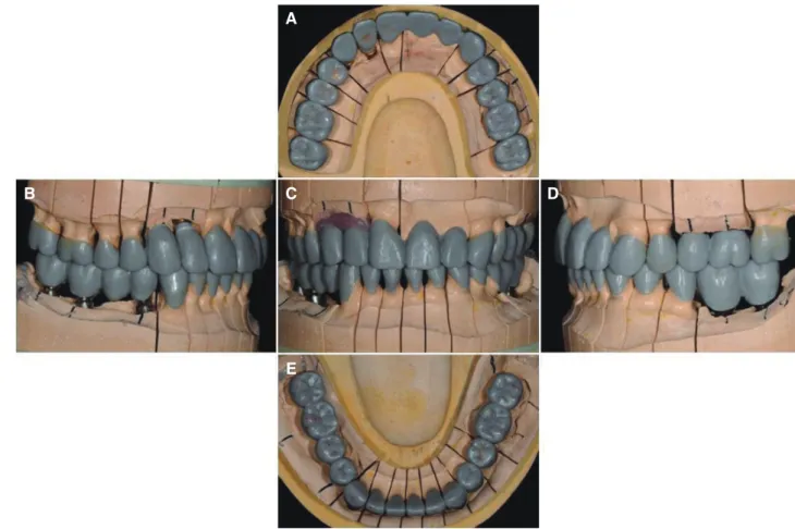 Fig. 11. Full contour wax-up for the definitive prosthesis. (A) Maxillary occlusal view, (B) Right lateral view, (C) Frontal  view at maximum inter-cuspal position (D) Left lateral view, (E) Mandibular occlusal view.