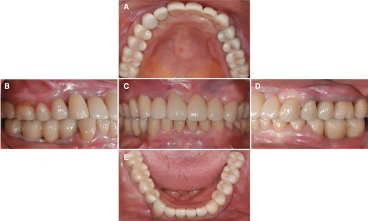 Fig. 13. Definitive prosthesis was delivered. Esthetics and functions were restored with the zirconia prosthesis