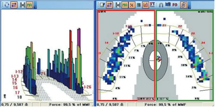 Fig. 15. Occlusal analysis using T scan III. Stable occlusion was present.