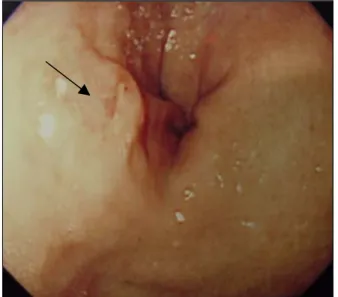 Fig. 3. View of PDT procedure; showing irradiation on neo- neo-plasms of stomach under endoscopy.