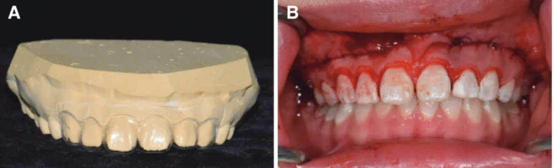 Fig. 6. Gingivectomy and lip repositioning. (A) Surgical splint for gingivectomy, (B) After gingivectomy and lip repositioning.