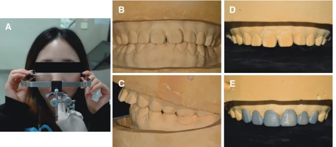 Fig. 8. Diagnostic model fabrication. (A) Face bow transfer, (B) Frontal view of diagnostic model, (C) Lateral view of  diagnostic model, (D) Diagnostic model of maxilla, (E) Diagnostic wax-up model of maxilla.