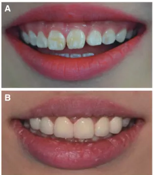 Fig. 12. Analysis of maxillary anterior tooth size and  proportion after treatment.