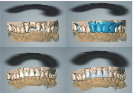 Fig. 18. CAD image of coping design using scanned and superimposed image. 