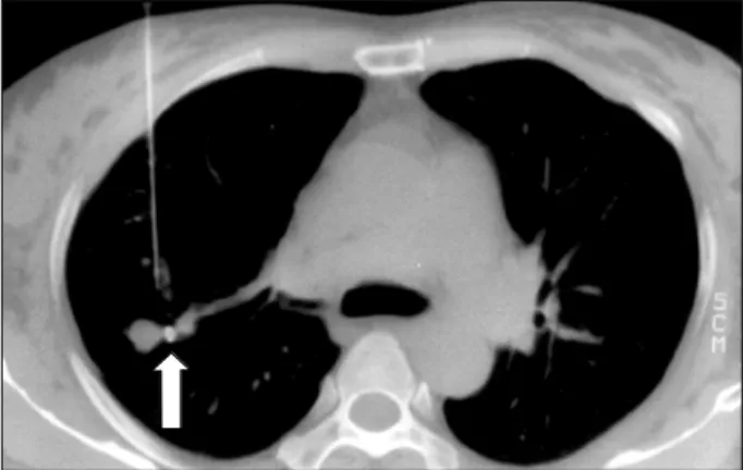 Fig. 1. Once the needle tip was confirmed to be just in contact  with the nodule, the stylet was removed from the needle, and a segment of platinum (arrowhead) was inserted by pushing the  stylet under chest CT guidance