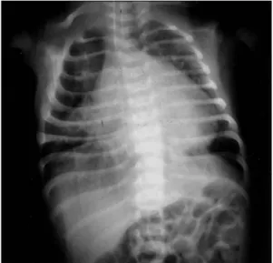 Fig. 1. Preoperative chest roentgenogram. 