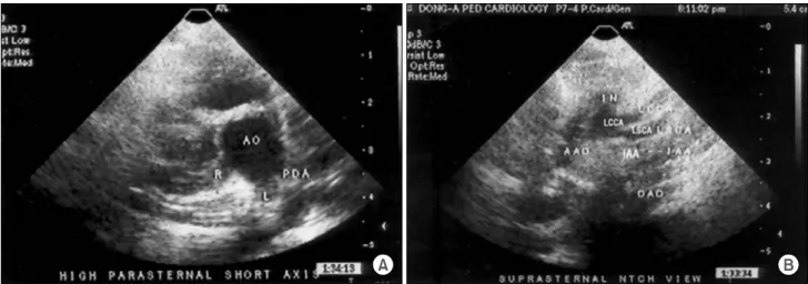 Fig. 2. Preoperative 2D echocardiography.  (A) High parasternal short axis view (B) Suprasternal notch view