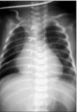 Fig. 4. Postoperative chest roentgenogram at discharge. 