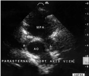 Fig. 7. Postoperative 2D echocardiogram 1 year after opera- opera-tion. Parasternal short axis view